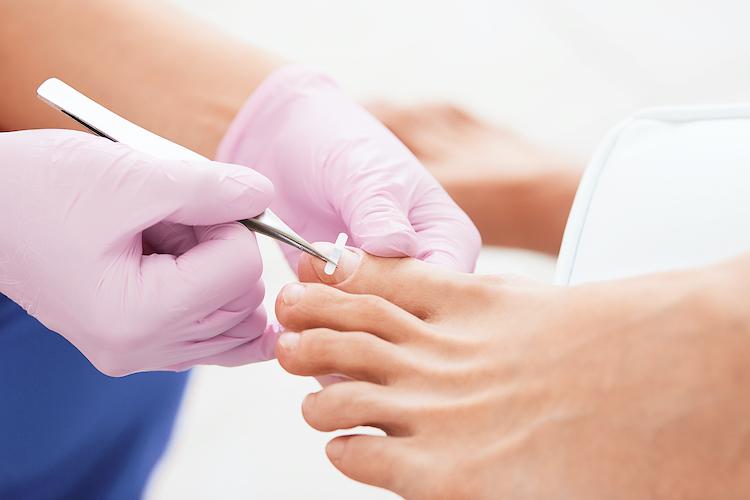 Nagelspange in Zürich für eingewachsene Zehennägel